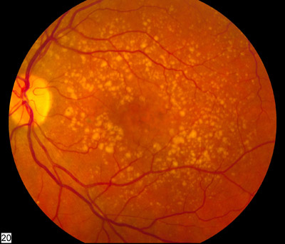 An eye undergoing age-related macular degeneration